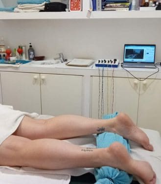 Acupuntura en las piernas