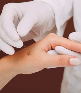 terapeuta haciendo acupuntura en la mano